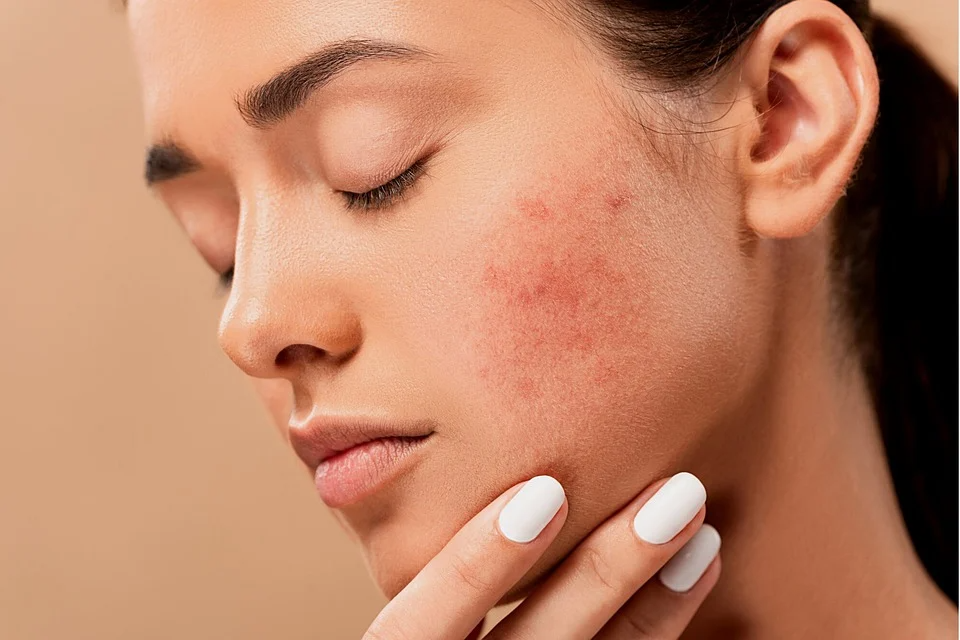 Rekomendasi Skincare Untuk Hilangkan Bekas Jerawat